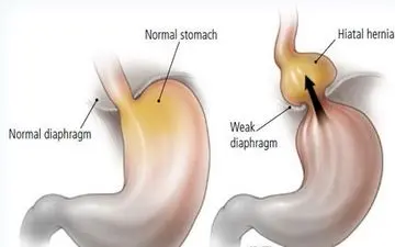 قرص برای درمان بلع معرفی شد؛ گامی جدید در بهبود اختلالات بلع