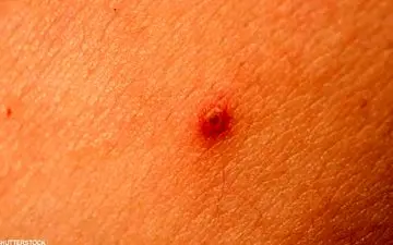 این ۲ علامت ساده روی پوستتان را نادیده نگیرید؛ ممکن است سرطان باشد!