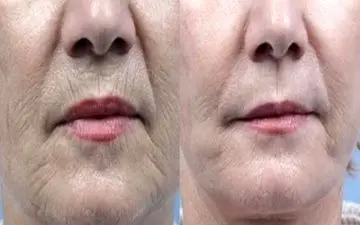 چگونه چین و چروک‌های دور لب را از بین ببریم؟