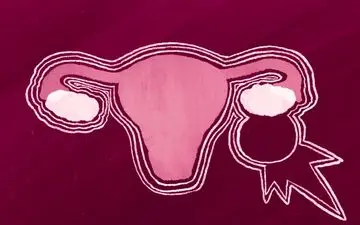 ترکیدن کیست تخمدان: علائم، دلایل و درمان‌های اورژانسی که باید بدانید!