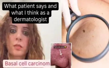 چند علامت عجیب روی پوست که ممکن است نشان‌دهنده سرطان باشند