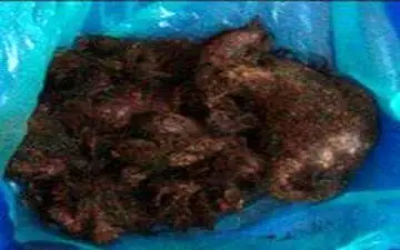 خارج کردن توده یک کیلویی "مو" از معده دختر 14 ساله