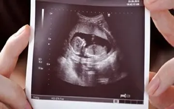 با طرح جدید مجلس منتظر تولد نوزادان دارای سندرم داون باشید!
