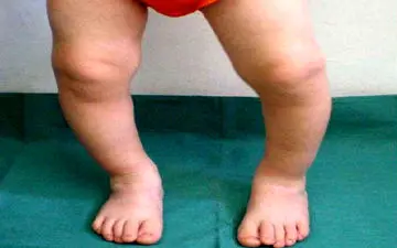 علت پای پرانتزی چیست؟