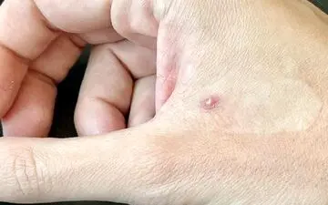 وضعیت آبله میمونی در کشور