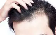 با کمبود این ویتامین‌ها دچار ریزش مو می‌شوید


