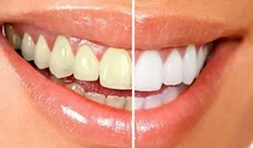 از شر جرم دندان با این روش‌های طبیعی خلاص خواهید شد