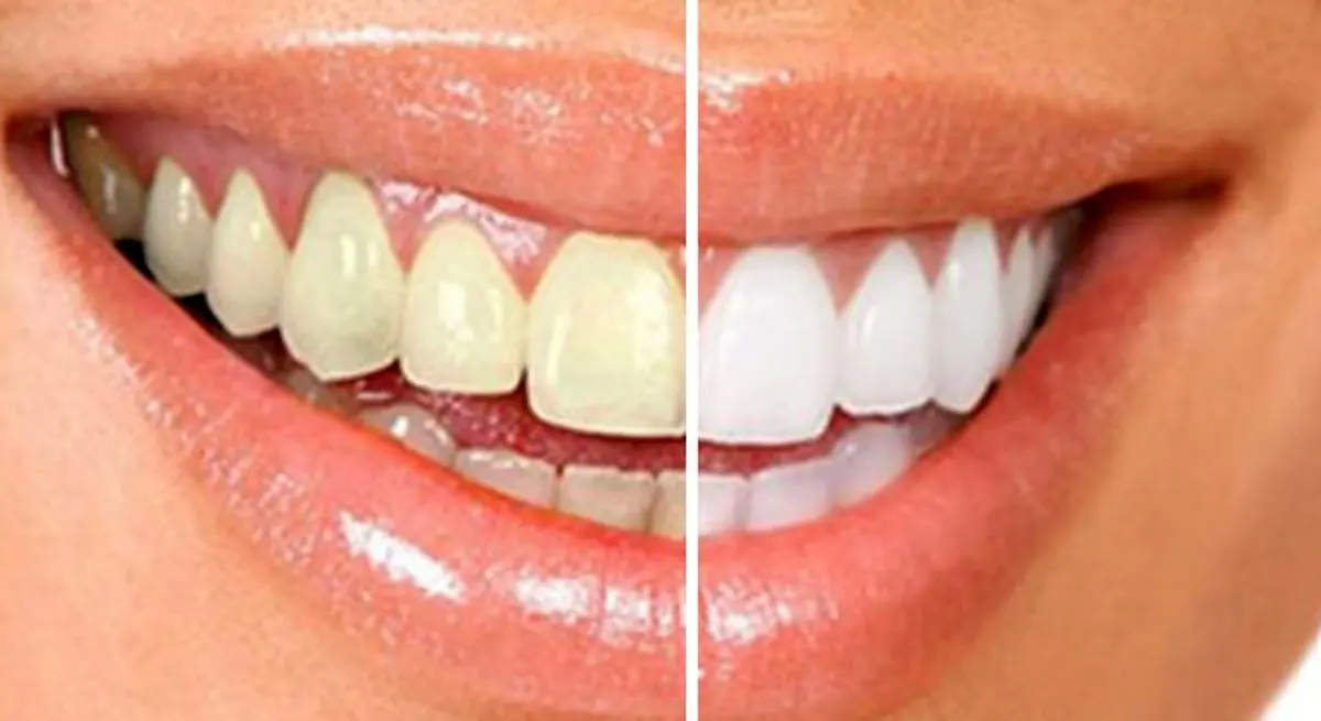 از شر جرم دندان با این روش‌های طبیعی خلاص خواهید شد