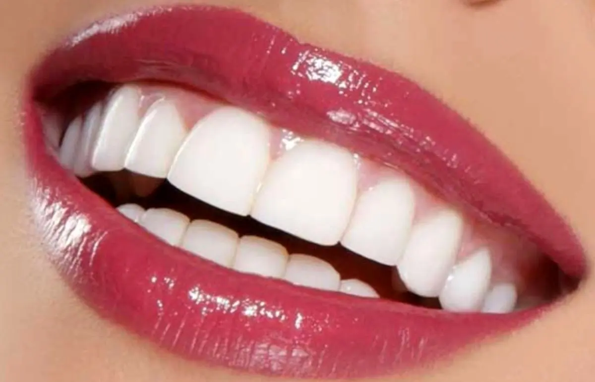 روش‌های سریع و موثر برای بهبود زیبایی دندان‌ها: نکاتی که باید بدانید
