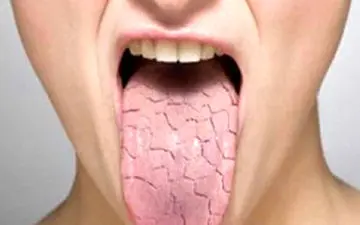 علائم بیماری شوگرن