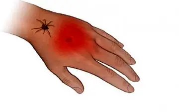 چطور نیش حشره را از بدن خارج کنیم؟ 