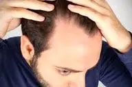 ایا ریزش مو ربطی به دیابت دارد؟