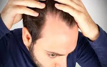 ایا ریزش مو ربطی به دیابت دارد؟