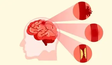 هشدار | سن شروع سکته مغزی کاهش پیدا کرده است