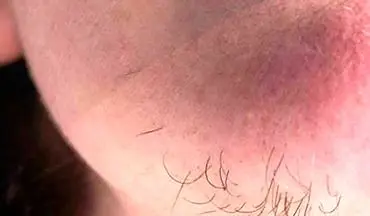 با این راهکار ساده از شر موهای زائد خلاص شوید!