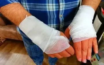 خمیردندان و سیب زمینی تاثیری برا درمان سوختگی دارد؟