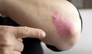 با بیماری پسوریازیس و علائم آن آشنا شوید