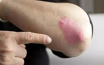 با بیماری پسوریازیس و علائم آن آشنا شوید