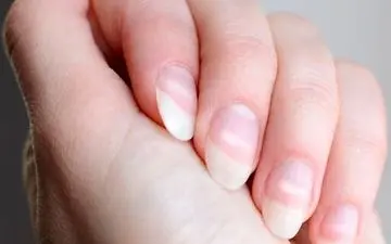 چه بیماری هایی از ظاهر ناخن‌ها مشخص است؟

