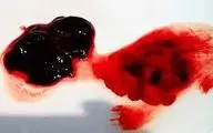 برای دفع لخته های خون این کارها را انجام دهید!