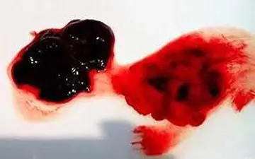 برای دفع لخته های خون این کارها را انجام دهید!