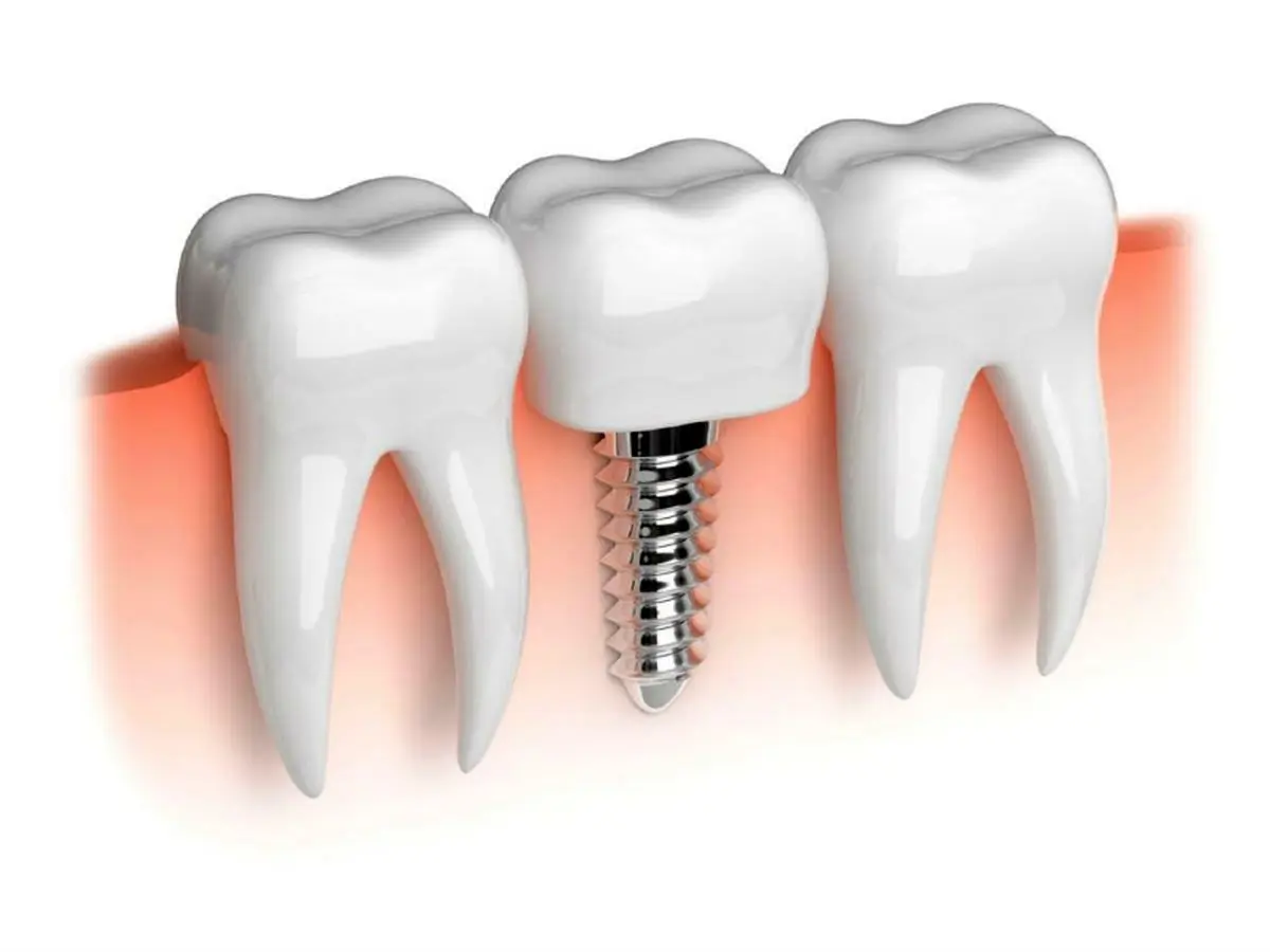 ایمپلنت های دندانی سرطان زا هستند