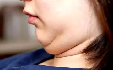 راهکاری برای از بین بردن غبغب