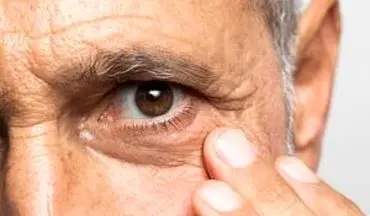 ورم صورت و التهاب زیر چشم چه علتی دارد؟