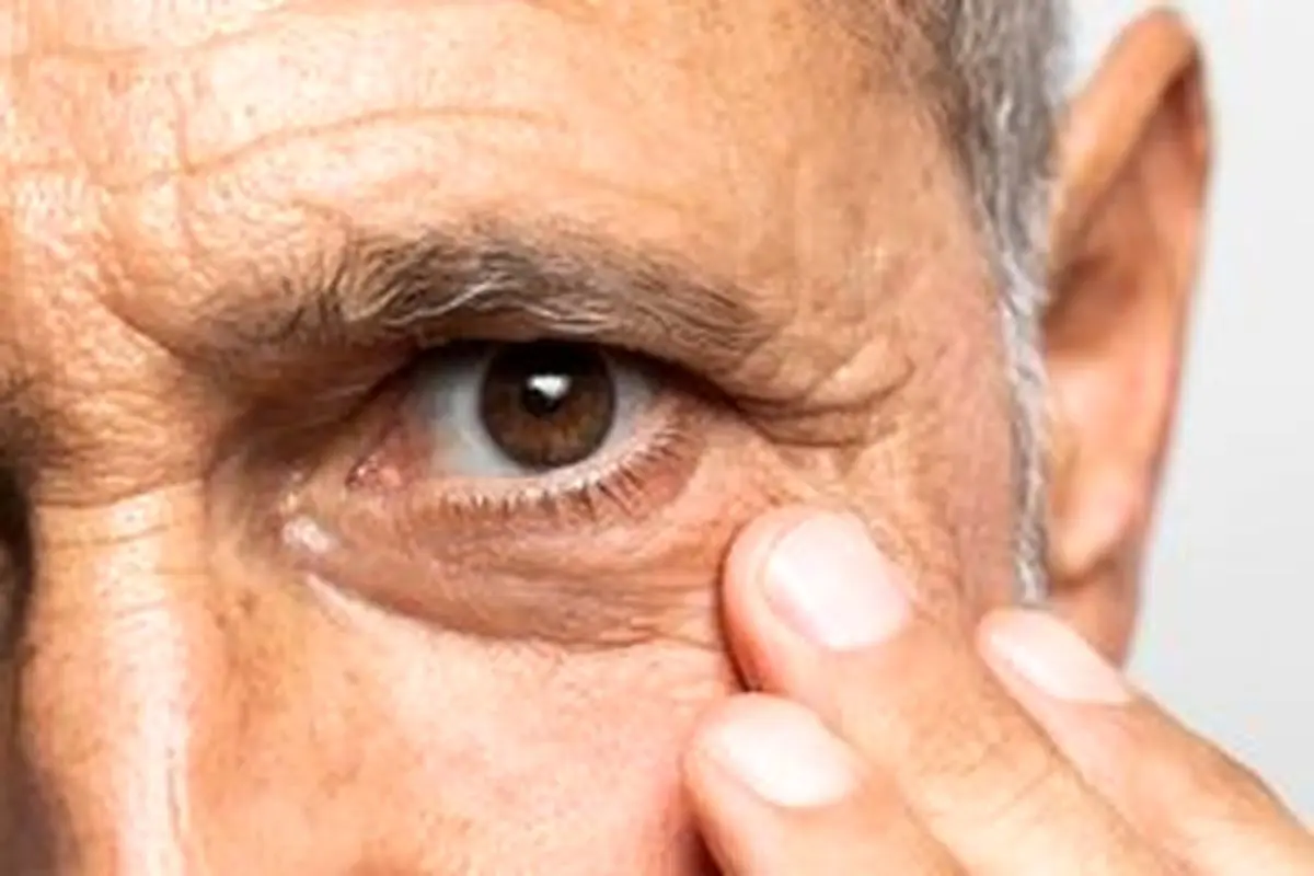 ورم صورت و التهاب زیر چشم چه علتی دارد؟