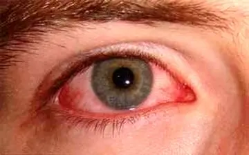 اگر در بهار دچار قرمزی چشم می‌شوید این خوراکی‌ها را نخورید