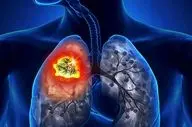 نقطه ضعف سرطان ریه کشف شد