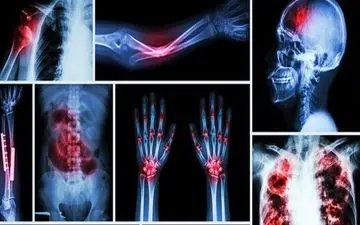 آشنایی با سرطان استخوان
