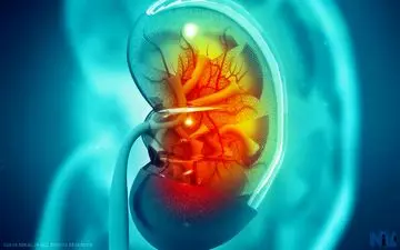 آشنایی با دیسپلازی کلیه