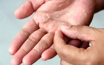 پوسته پوسته شدن کف دست، علامتی از کمبود این ویتامین ها