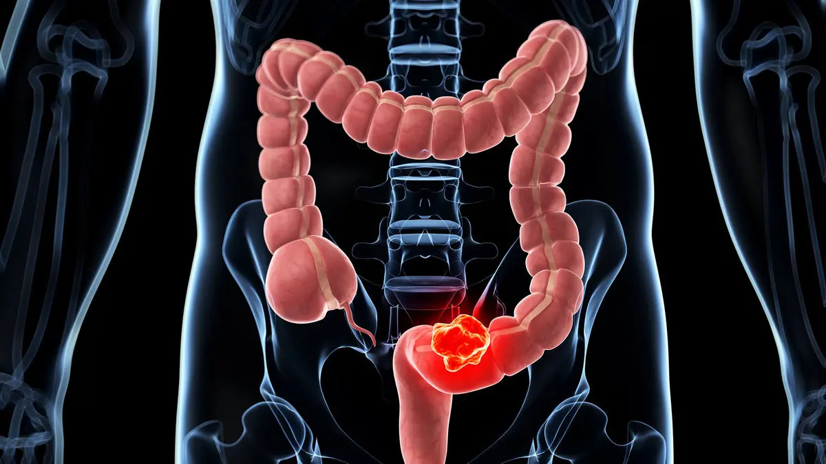 ابتلای افراد جوان به سرطان روده | این چهار علامت را حتما جدی بگیرید!
