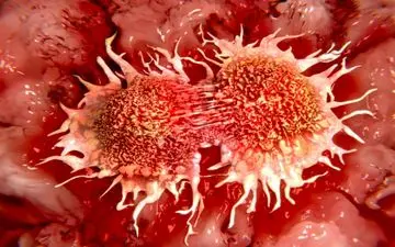 توده‌های غیرسرطانی که نیازی به درمان ندارند