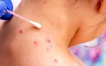 آنچه باید در مورد آبله میمونی باید بدانید