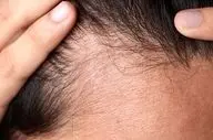 4 تکنیک ساده برای جلوگیری از ریزش مو