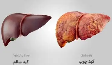 کاهش خطر کبد چرب با لوبیا و سویا/ چگونه این پروتئین‌های گیاهی کمک می‌کنند؟
