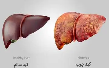 کاهش خطر کبد چرب با لوبیا و سویا/ چگونه این پروتئین‌های گیاهی کمک می‌کنند؟