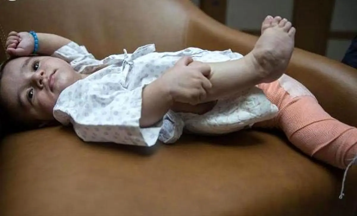 کودک عجیب الخلقه با 8 دست و پا به دنیا آمد! / تصاویر + 18