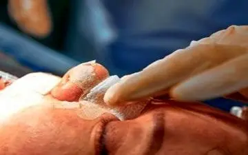 مرگ بر اثر جراحی بینی ممکن است؟