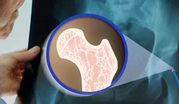 پوکی استخوان را با این راهکارهای ساده درمان کنید
