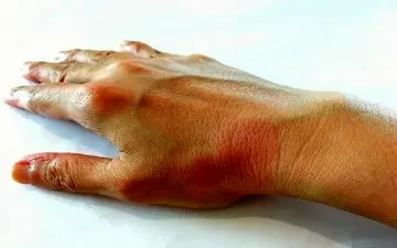  یائسگی زود هنگام؛ یکی از عوامل ابتلا به بیماری‌های خودایمنی در زنان

