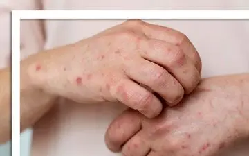 مشکلات پوستی که خبر از بیماری داخلی می‌دهند
