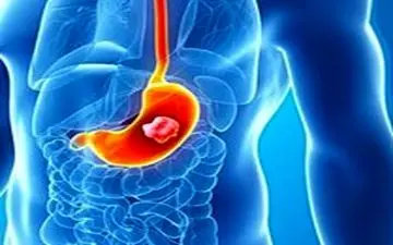 زخم معده را با این غذاها درمان کنید