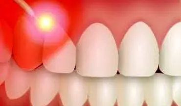 با کاربردهای جالب لیزر در دندانپزشکی آشنا شوید 