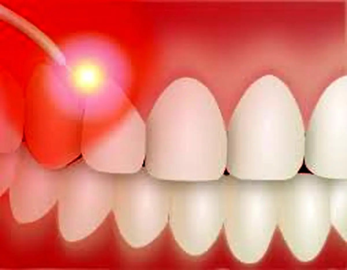 با کاربردهای جالب لیزر در دندانپزشکی آشنا شوید 