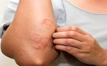 علائم ظاهری هپاتیت برروی پوست