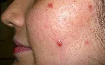 سندرومی شایع و وحشتناک در ورای جوش‌های صورت